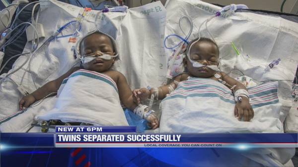 Conjoined twins successfully separated at Le Bonheur Children's Hospital