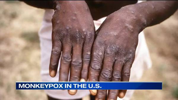 WATCH: Mid-South doctors on alert after Monkeypox found in US